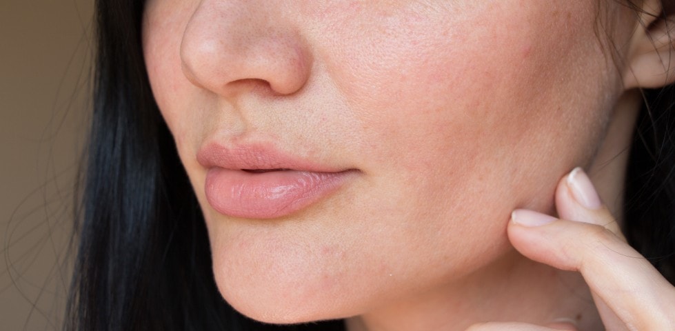 Follikel-Filamente erkennen und behandeln: Das musst du wissen