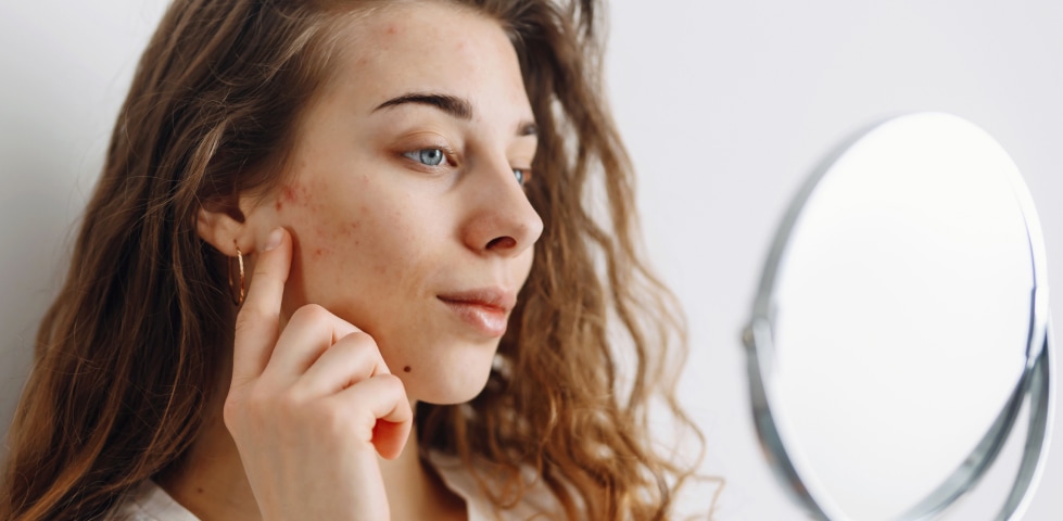 Pickel an der Schläfe: Ursachen verstehen und effektiv behandeln